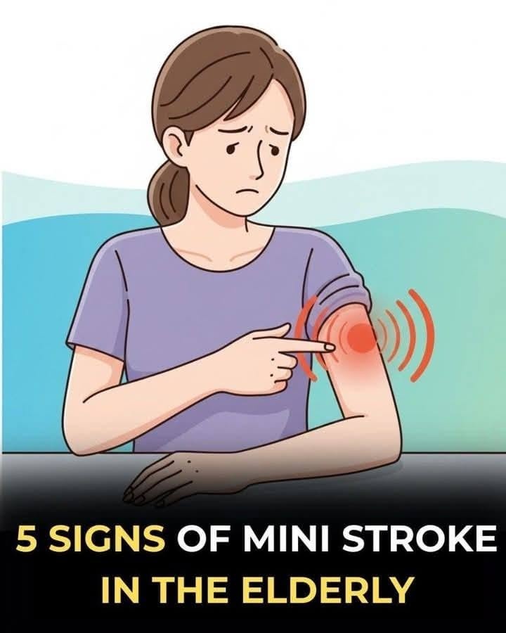 ministroke
